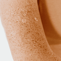 Sonnengeschädigte Haut – Was tun?