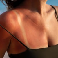 Sonnenbrand - Vorbeugung, Behandlung und langfristige Auswirkungen