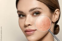 Couperose – der Fluch der Kelten